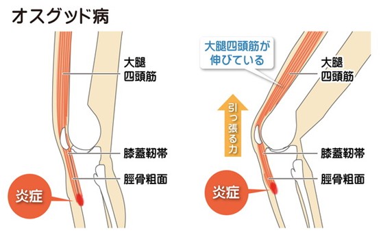 オスグッド病